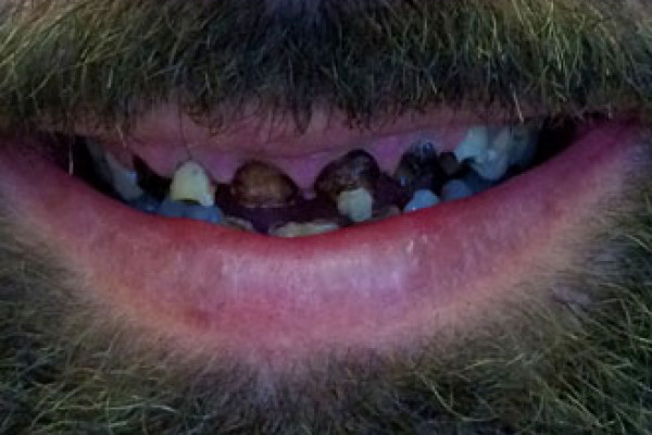 Battle Ground Full Mouth Reconstruction