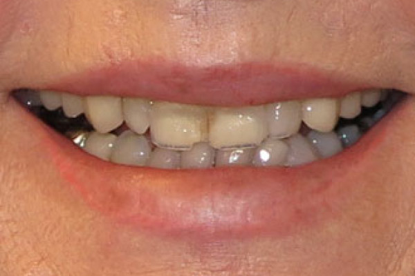 Dental Implants Dentist Battle Ground