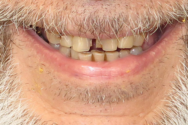 Family Dentist in Battle Ground