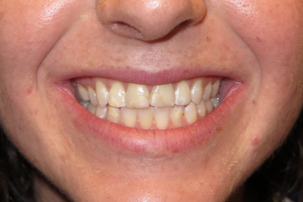 Teeth Replacement Battle Ground