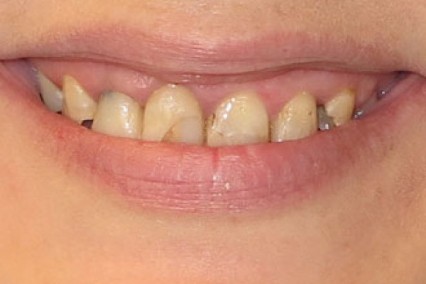 Battle Ground Full Mouth Reconstruction