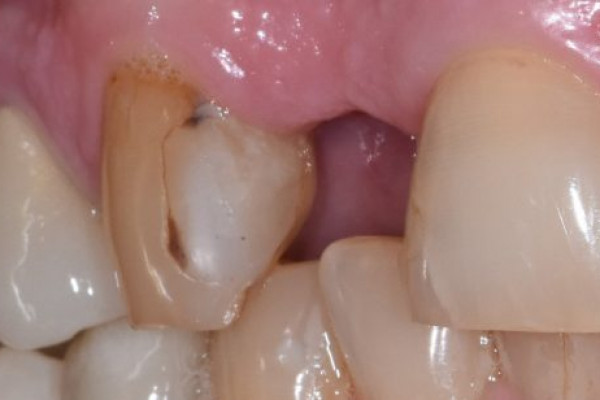 Pediatric Dentist near Battle Ground