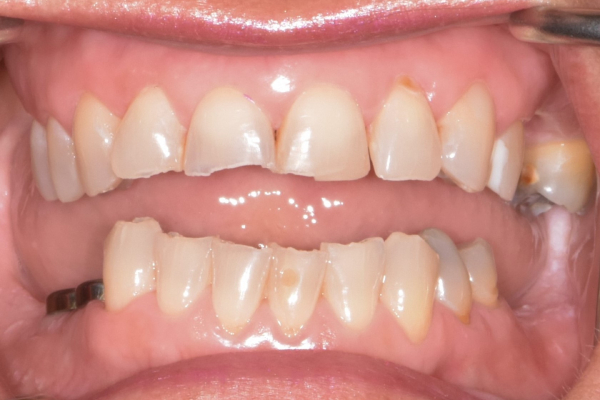 Dental Implants Dentist Battle Ground