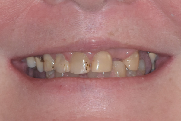 Above   Beyond Dentistry   Implants | Tooth Colored Fillings, Dentures and All-on-X
