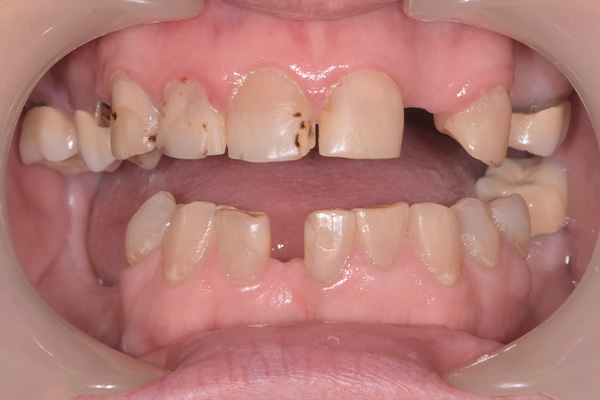 Above & Beyond Dentistry & Implants | All-on-X, Extractions and Bone Grafting