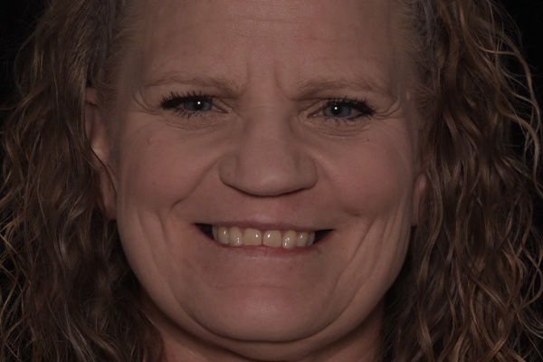 Above   Beyond Dentistry   Implants | Dentures, Bone Grafting and Extractions