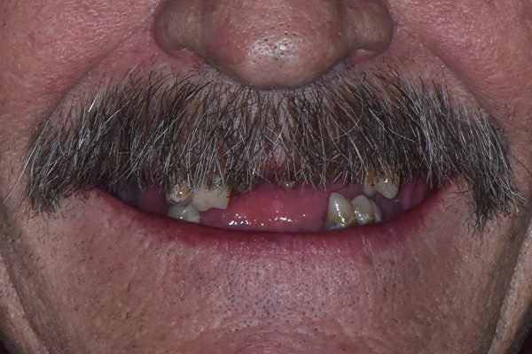 Above & Beyond Dentistry & Implants | All-on-X, Oral Hygiene and Wisdom Teeth Extractions