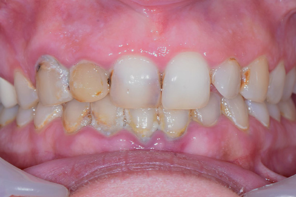 Above & Beyond Dentistry & Implants | Root Canals, Wisdom Teeth Extractions and Chao Pinhole® Gum Rejuvenation