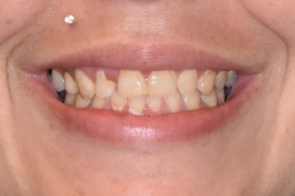 Above & Beyond Dentistry & Implants | Extractions, Gum Disease and Tooth Colored Fillings