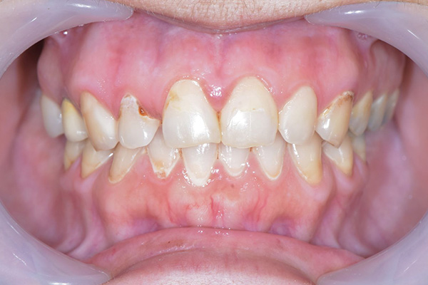 Above & Beyond Dentistry & Implants | Sedation Dentistry, Dentures and Wisdom Teeth Extractions