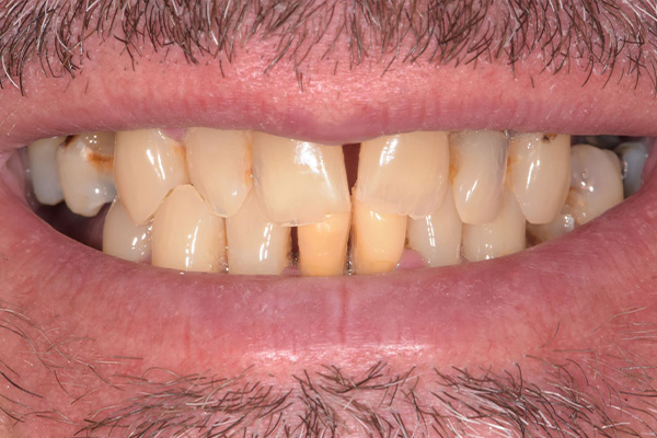 Above & Beyond Dentistry & Implants | Oral Hygiene, Dentures and Extractions