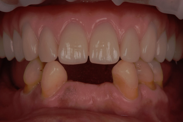 Above & Beyond Dentistry & Implants | Wisdom Teeth Extractions, Bridges and Dentures
