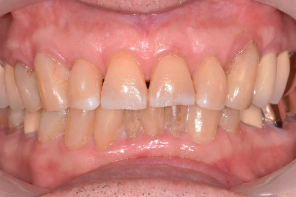 Above & Beyond Dentistry & Implants | All-on-X®, Bone Grafting and Sedation Dentistry