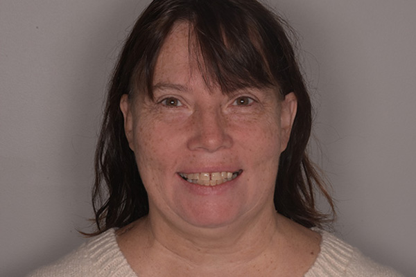 Above & Beyond Dentistry & Implants | TMJ & TMD, Teeth Whitening and Crowns