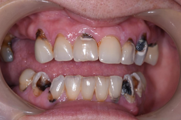 Above & Beyond Dentistry & Implants | All-on-X®, Oral Hygiene and Dentures