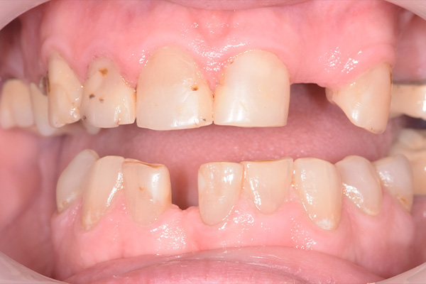 Above   Beyond Dentistry   Implants | Dentures, Root Canals and All-on-X reg 