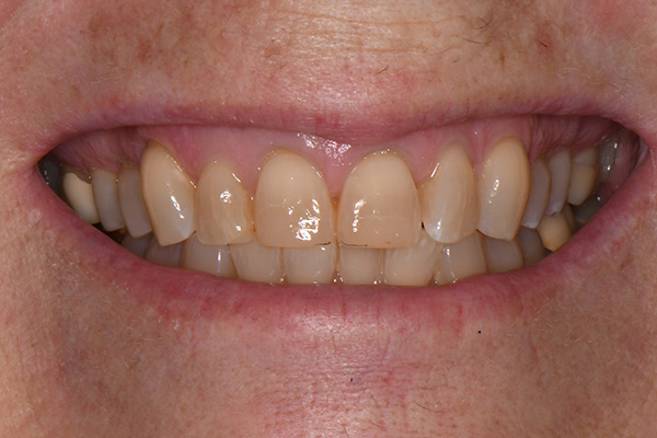 Above & Beyond Dentistry & Implants | Bone Grafting, Bridges and All-on-X®