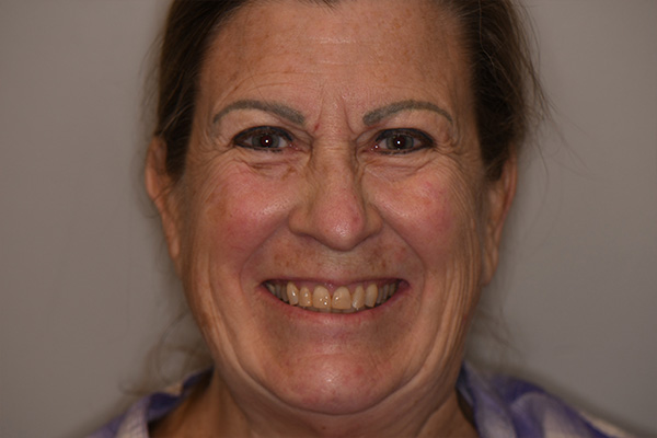 Above & Beyond Dentistry & Implants | Bridges, Root Canals and All-on-X®