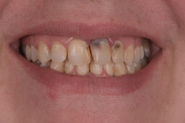 Above & Beyond Dentistry & Implants | Dental Implants, Extractions and Dentures