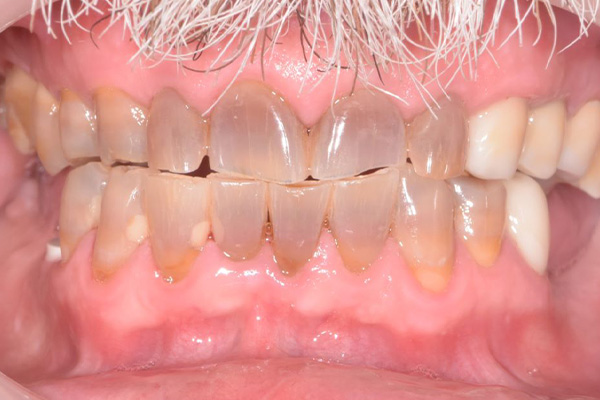 Above & Beyond Dentistry & Implants | Veneers, Full Mouth Reconstruction and Dental Implants