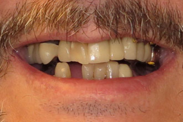 Teeth Replacement Battle Ground