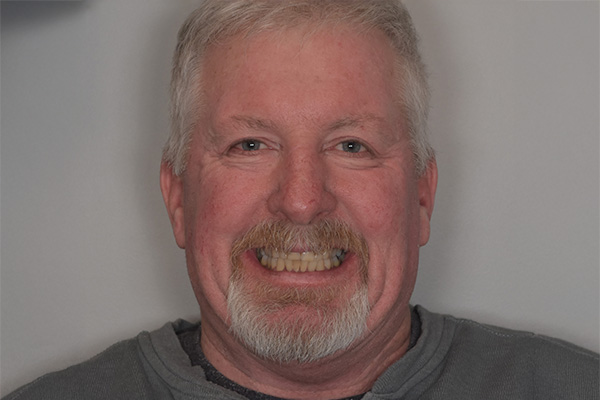 Above & Beyond Dentistry & Implants | Bridges, Chao Pinhole® Gum Rejuvenation and Veneers