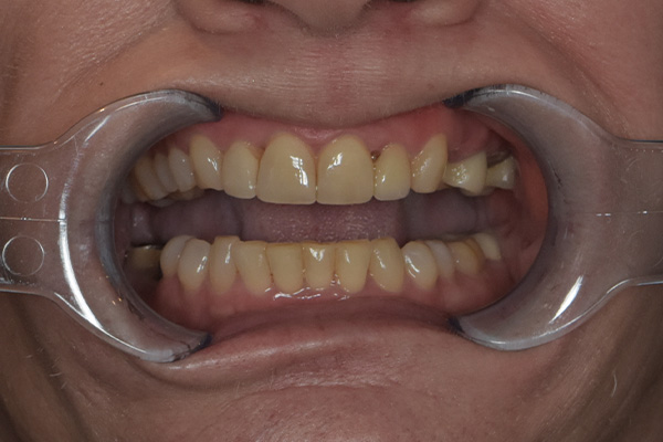 Above & Beyond Dentistry & Implants | Gum Disease, Teeth Whitening and Crowns