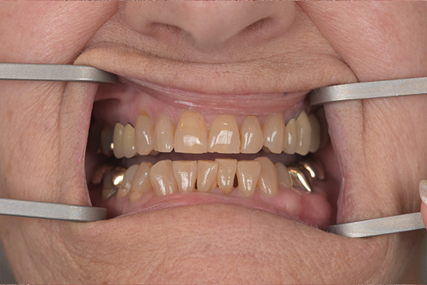 Above & Beyond Dentistry & Implants | Crowns, Extractions and Oral Hygiene