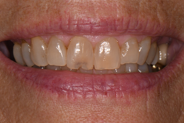 Above & Beyond Dentistry & Implants | Root Canals, Bridges and Extractions