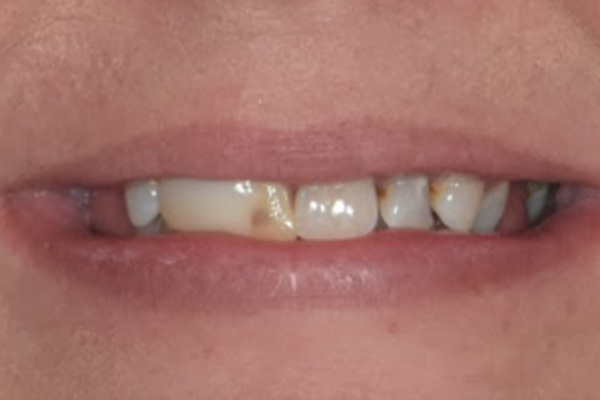 Above & Beyond Dentistry & Implants | Extractions, Oral Hygiene and Wisdom Teeth Extractions