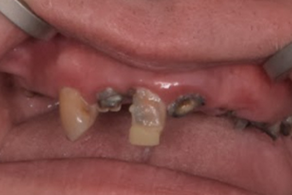 Above & Beyond Dentistry & Implants | Bridges, Dentures and Chao Pinhole® Gum Rejuvenation