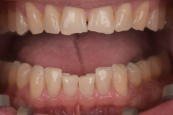 Above & Beyond Dentistry & Implants | Wisdom Teeth Extractions, Bone Grafting and TMJ & TMD