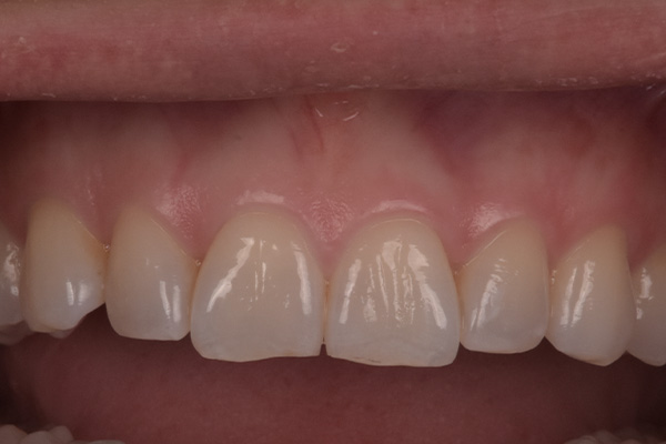 Above & Beyond Dentistry & Implants | Bridges, Extractions and Tooth Colored Fillings