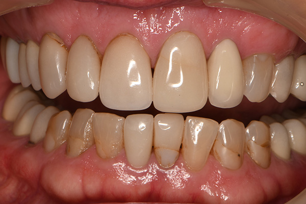 Above & Beyond Dentistry & Implants | Bone Grafting, Crowns and Tooth Colored Fillings