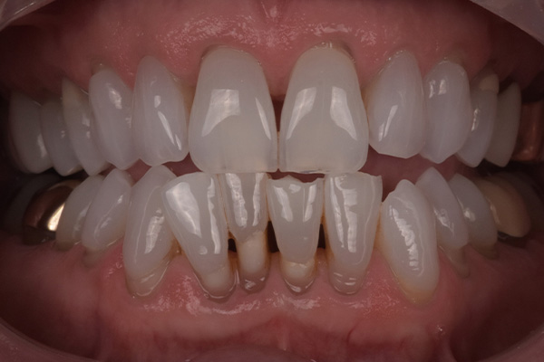 Above & Beyond Dentistry & Implants | Full Mouth Reconstruction, Crowns and TMJ & TMD
