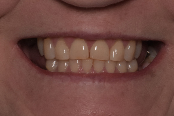 Above Beyond Dentistry Implants | Gum Disease, Dentures and Root Canals