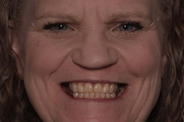 Above Beyond Dentistry Implants | Oral Hygiene, Tooth Colored Fillings and Veneers