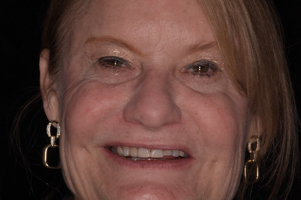 Above Beyond Dentistry Implants | Gum Disease, Teeth Whitening and Chao Pinhole reg Gum Rejuvenation