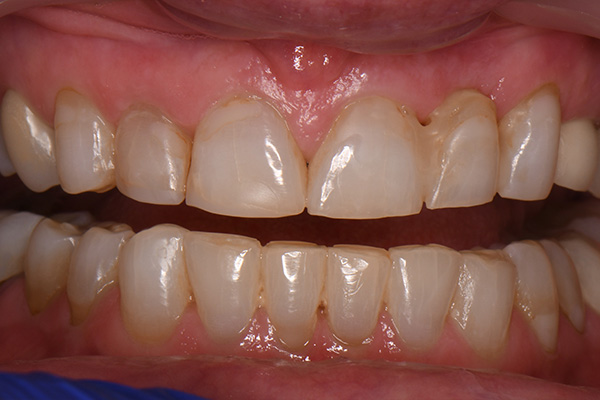 Above Beyond Dentistry Implants | Oral Hygiene, Teeth Whitening and Tooth Colored Fillings
