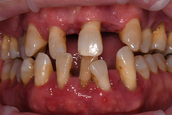 Above Beyond Dentistry Implants | Crowns, Wisdom Teeth Extractions and Bridges