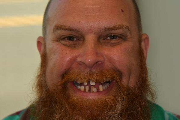 Above Beyond Dentistry Implants | Wisdom Teeth Extractions, Chao Pinhole reg Gum Rejuvenation and Root Canals