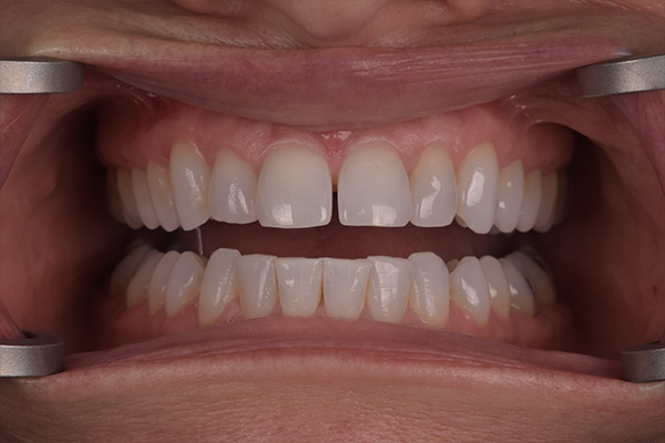 Above & Beyond Dentistry & Implants | Crowns, TMJ & TMD and Bone Grafting