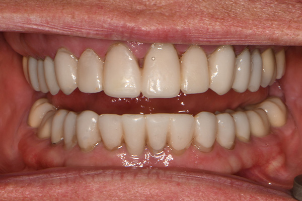 Above Beyond Dentistry Implants | Dental Implants, Gum Disease and Sedation Dentistry