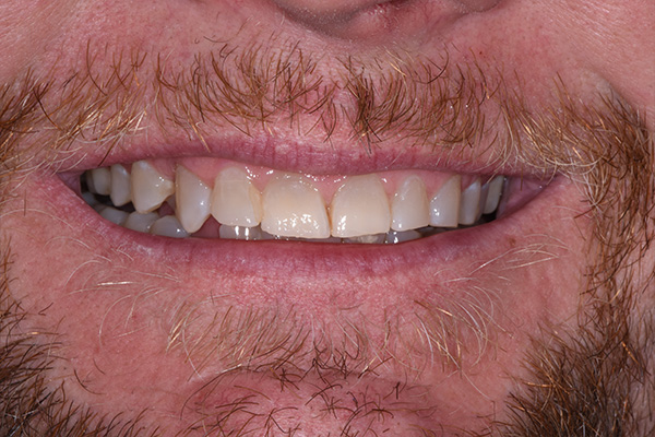 Above & Beyond Dentistry & Implants | Gum Disease, Bone Grafting and Veneers