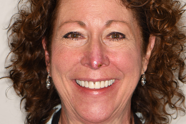 Above Beyond Dentistry Implants | Wisdom Teeth Extractions, All-on-X reg and Tooth Colored Fillings