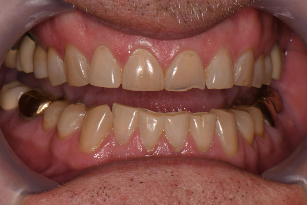 Above   Beyond Dentistry   Implants | Wisdom Teeth Extractions, Gum Disease and Dental Implants