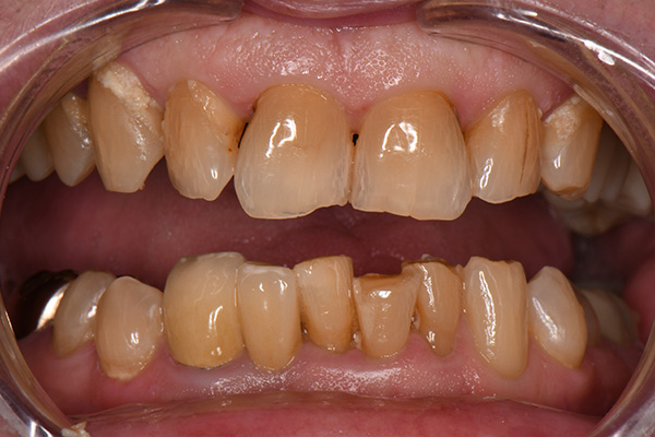 Above   Beyond Dentistry   Implants | Sedation Dentistry, Chao Pinhole reg  Gum Rejuvenation and Gum Disease