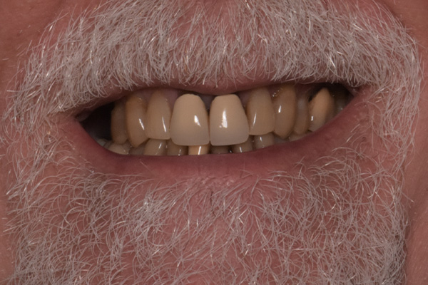 Above Beyond Dentistry Implants | Tooth Colored Fillings, Wisdom Teeth Extractions and Dental Implants