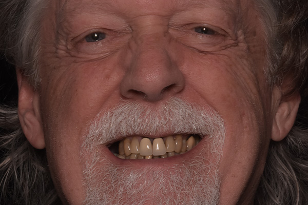 Above Beyond Dentistry Implants | Bone Grafting, Bridges and Dental Implants