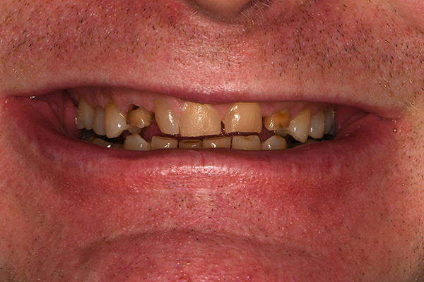 Above & Beyond Dentistry & Implants | Chao Pinhole&reg; Gum Rejuvenation, Dental Implants and Wisdom Teeth Extractions